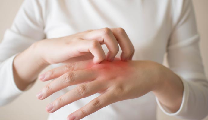 Person scratching red and irritated skin on hand showing visible signs of an allergic reaction